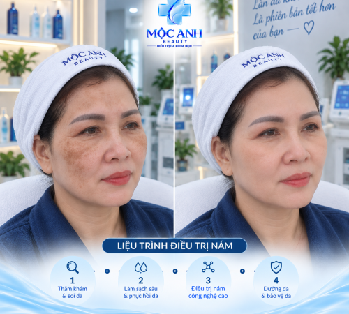 Liệu Trình Điều Trị Nám, Tàn Nhang, Đồi Mồi