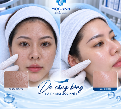 PEEL CĂNG MỊN - CĂNG BÓNG - TÁI SINH DA 