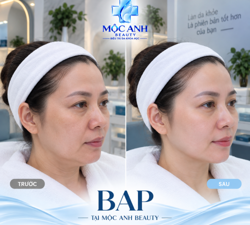 BAP Nâng Cơ